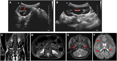 A Case of Congenital Nephrogenic Diabetes Insipidus Caused by Thr108Met Variant of Aquaporin 2